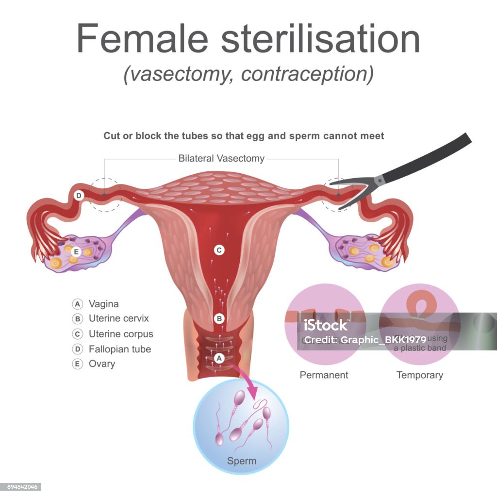 Female sterilisation vasectomy. The male reproductive system these work together to produce sperm. Cut or block the tubes so that egg and sperm cannot meet. Female Likeness stock vector
