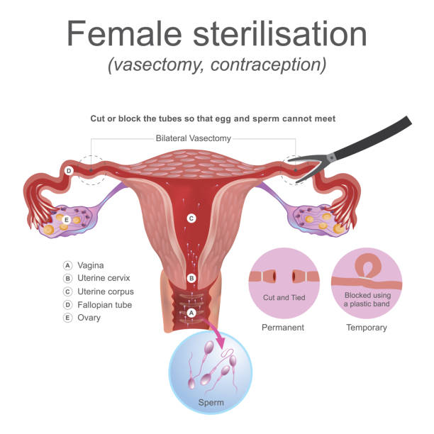 Female sterilisation vasectomy. The male reproductive system these work together to produce sperm. Cut or block the tubes so that egg and sperm cannot meet. family planning together stock illustrations