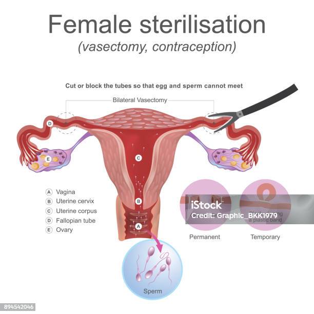 Female Sterilisation Vasectomy Stock Illustration - Download Image Now - Female Likeness, Vasectomy, Anatomy