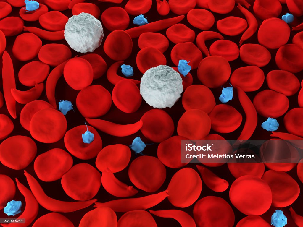 Sickle cell anemia 3d render of sickle cell anemia blood cells Sickle Cell Anemia Stock Photo