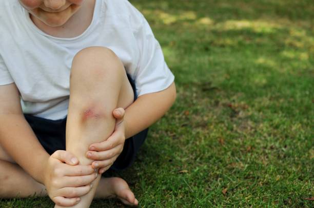 Childhood injuries Young boy holds a sore leg that received a injury while playing outdoors. bruise stock pictures, royalty-free photos & images