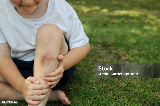 Childhood Injuries Stock Photo - Download Image Now - Child, Bruise, Wound