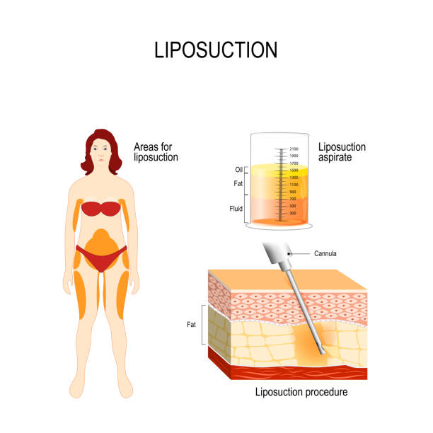Liposuction Process 2,200+ Liposuction Procedures Stock Illustrations, Royalty-Free Vector ...