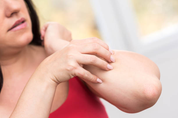 istock Woman having itchy and scratching her arm 895675124