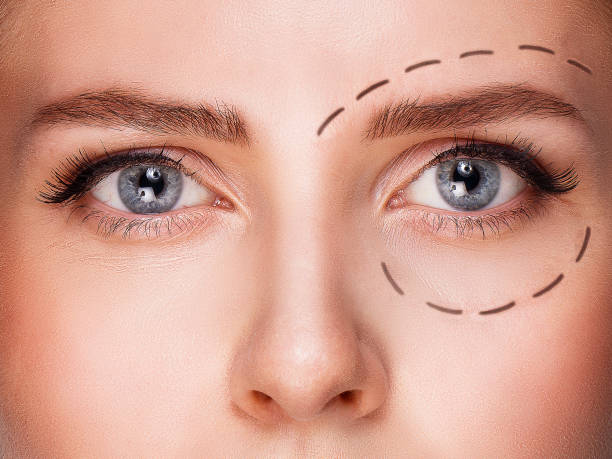 istock Blue eyed woman with markings below eye before plastic surgery 895799316