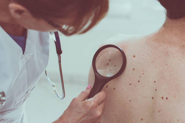 Dermatologist examining the skin of a patient Dermatologist examining the skin on the back of a patient mole skin stock pictures, royalty-free photos & images
