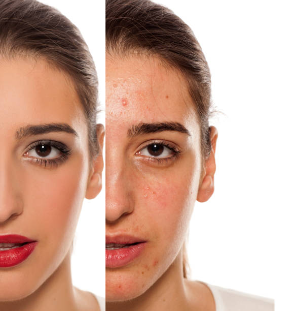istock Comparision of before anf after mkeup on young woman with a problematic skin on her face 896093902