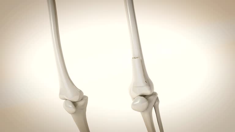 3,107 Osteoporosis Stock Videos and Royalty-Free Footage - iStock | Osteoporosis bone, Bone density, Bone 3,107 Osteoporosis Stock Videos and Royalty-Free Footage - iStock | Osteoporosis bone, Bone density, Bone