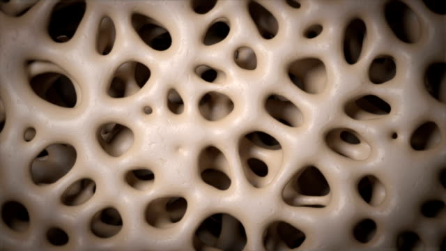 3,107 Osteoporosis Stock Videos and Royalty-Free Footage - iStock |  Osteoporosis bone, Bone density, Bone