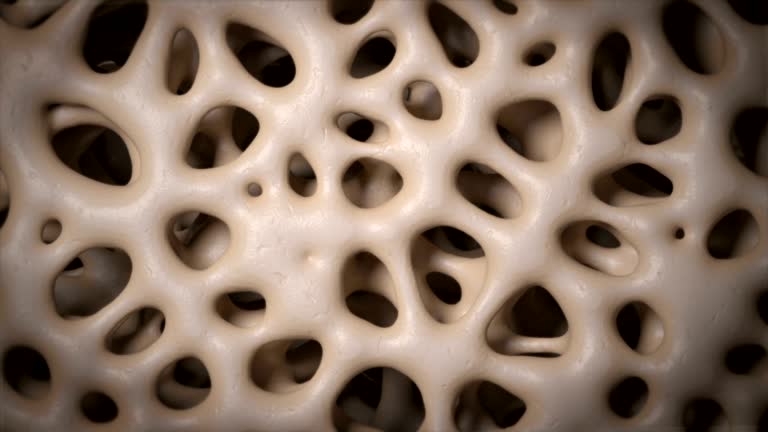 3,107 Osteoporosis Stock Videos and Royalty-Free Footage - iStock | Osteoporosis bone, Bone density, Bone 3,107 Osteoporosis Stock Videos and Royalty-Free Footage - iStock | Osteoporosis bone, Bone density, Bone