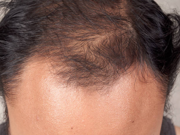 istock closeup of hair lose 896491998