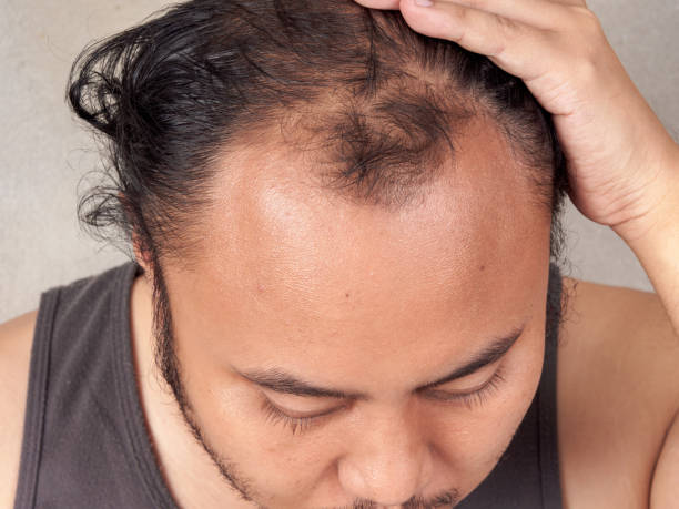 istock closeup of hair lose 896492148