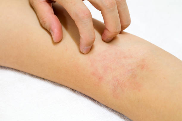 istock Women's hands are scratching allergy to red rash on white background 896765174