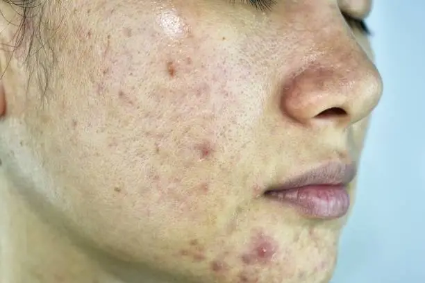 Skin problem with acne diseases, Close up woman face with whitehead pimples, Menstruation breakout, Scar and oily greasy face, Beauty concept.