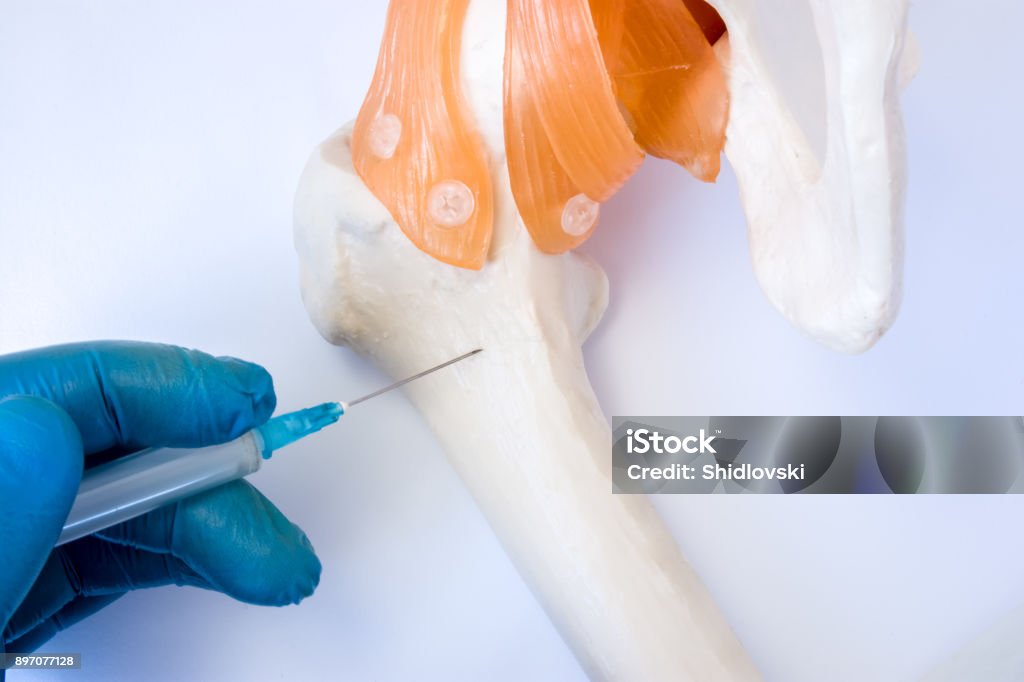 Bone marrow examination procedure: biopsy, aspiration or paracentesis concept photo. Doctor holds in hand dressed in glove syringe needle and puncture model of hip bone to take analysis of bone marrow Bone Marrow Stock Photo