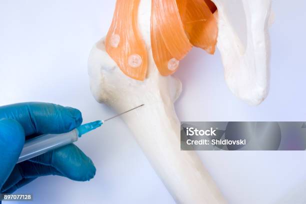 Bone Marrow Examination Procedure Biopsy Aspiration Or Paracentesis Concept Photo Doctor Holds In Hand Dressed In Glove Syringe Needle And Puncture Model Of Hip Bone To Take Analysis Of Bone Marrow Stock Photo - Download Image Now