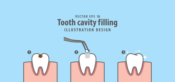 schritt der zahn hohlraum füllen illustration vektor auf blauem hintergrund. dental konzept. - filling stock-grafiken, -clipart, -cartoons und -symbole