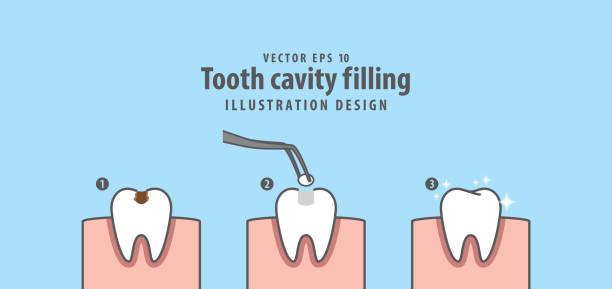 ilustraciones, imágenes clip art, dibujos animados e iconos de stock de paso de vector de ilustración de relleno de cavidad de diente sobre fondo azul. concepto dental. - filling