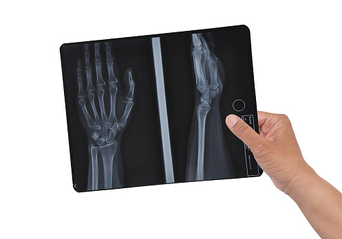 Hand X-ray held on white background