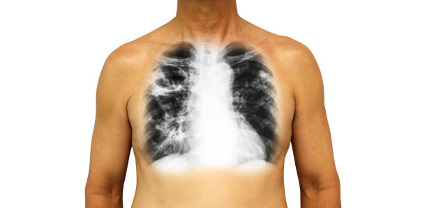 gruźlica płuc . ludzka klatka piersiowa z prześwietleniem pokazuje jamę w prawym górnym płucu i śródmiąższowy naciek obu płuc z powodu infekcji. odizolowane tło - interstitial zdjęcia i obrazy z banku zdjęć
