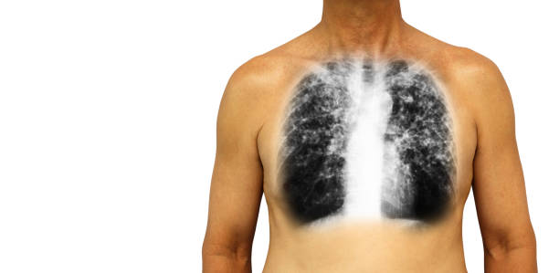 폐 결핵입니다. 인간의 가슴 x 선 모두 폐 감염에의 한 간 질 성 침투를 보여줍니다. 격리 된 배경입��니다. 왼쪽에 빈 영역 - interstitial 뉴스 사진 이미지
