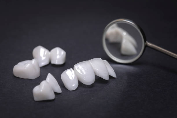 Dental mirror with zircon dentures on a dark background - Ceramic veneers - lumineers zircon dentures is a perfect dental cosmetics porcelain photos stock pictures, royalty-free photos & images