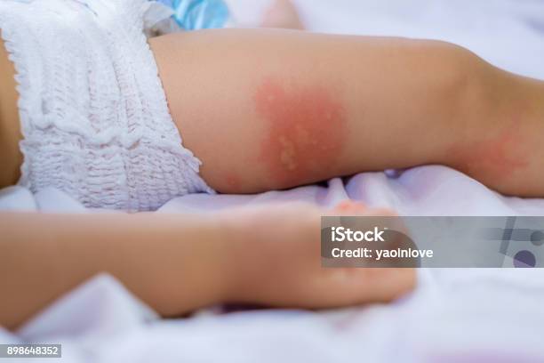 Klein Kind Met Roodheid Op De Huid Die Lijden Aan Allergieën Van Het Voedsel Stockfoto en meer beelden van Allergie