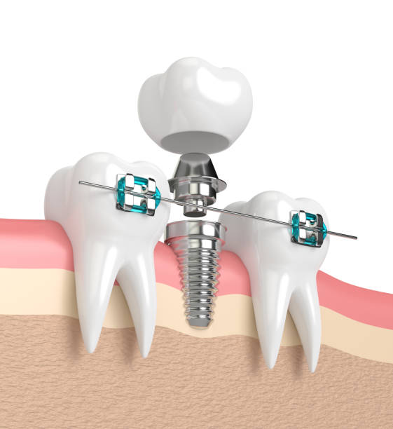 istock 3d render of teeth with implant and braces 898664274
