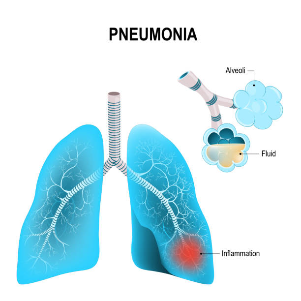 ilustraciones, imágenes clip art, dibujos animados e iconos de stock de neumonía. los pulmones y alvéolos inflamados - neumonía