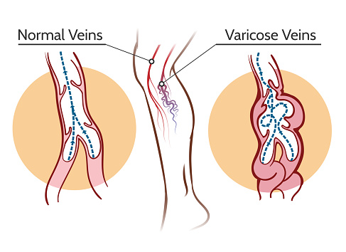 Varicose Veins Illustration Stock Illustration - Download Image Now - Varicose  Vein, Vein Valve, Vein - iStock