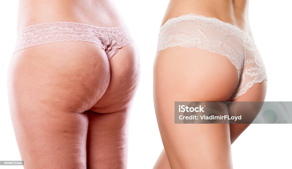 comparison of two women buttocks with and without cellulite Cellulite Stock Photo