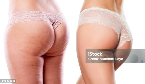 Comparison Of Two Women Buttocks With And Without Cellulite Stock Photo - Download Image Now