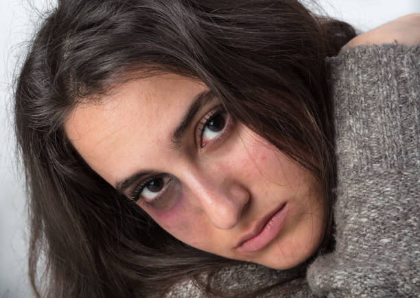 istock Attractive woman with a bruised black eye 898962424