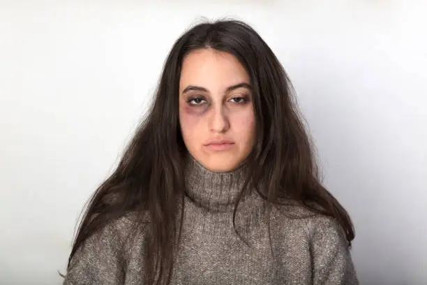 Abused woman with a bruised black eye the victim of domestic violence posing against a white studio background staring at camera