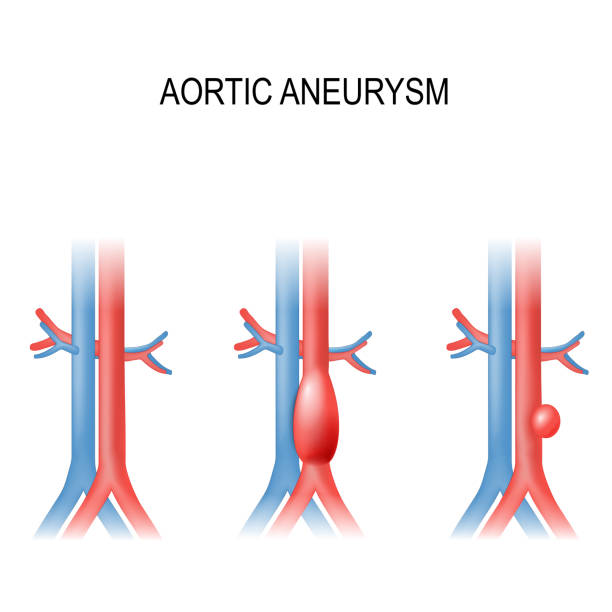 illustrazioni stock, clip art, cartoni animati e icone di tendenza di aneurisma aortico addominale - aorta
