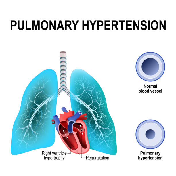 ilustraciones, imágenes clip art, dibujos animados e iconos de stock de hipertensión pulmonar - human vein illustrations
