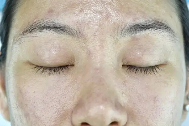 Photo of Facial skin problem, Aging problem in adult, wrinkle, acne scar, large pore, dark spot, dehydrate skin.