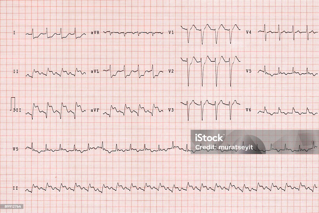 ecg von amyocardial infarct in einem Notfall-XL - Lizenzfrei Ausrüstung und Geräte Stock-Foto