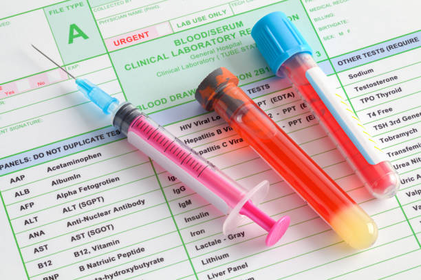 Blood Lab Work Blood Vials and Syringe with Needle on Top of Lab Results. cerebrospinal fluid photos stock pictures, royalty-free photos & images