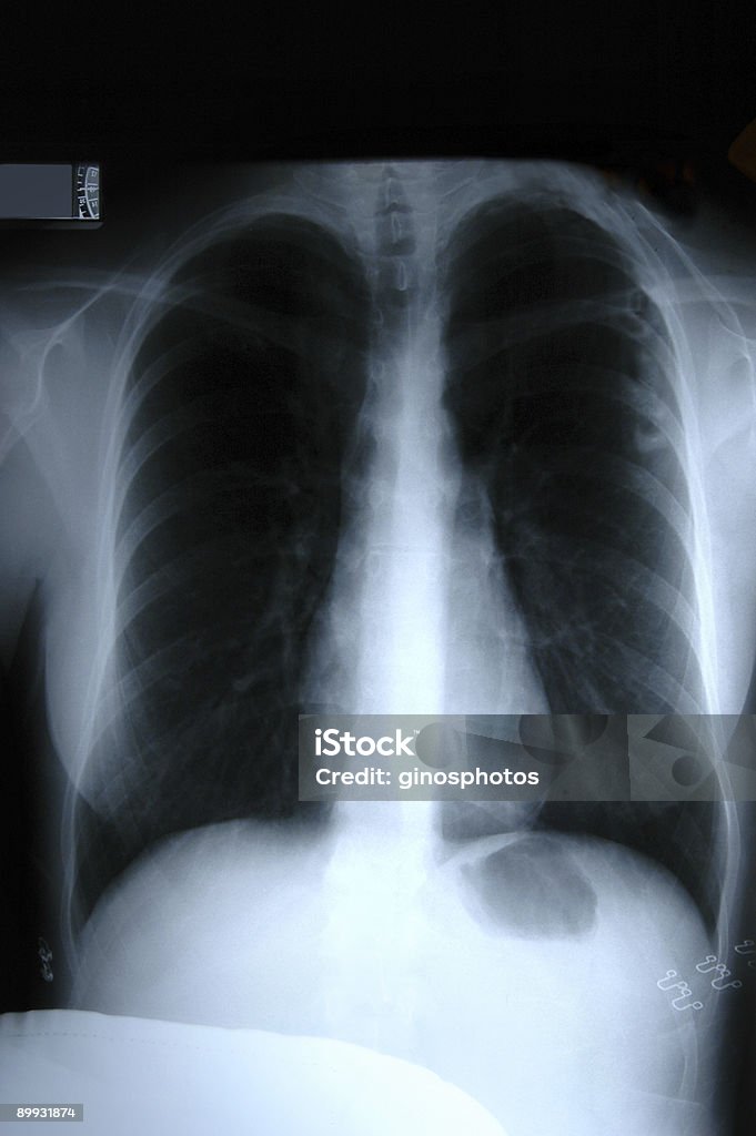 Radiografia del torace - Foto stock royalty-free di Anatomia umana