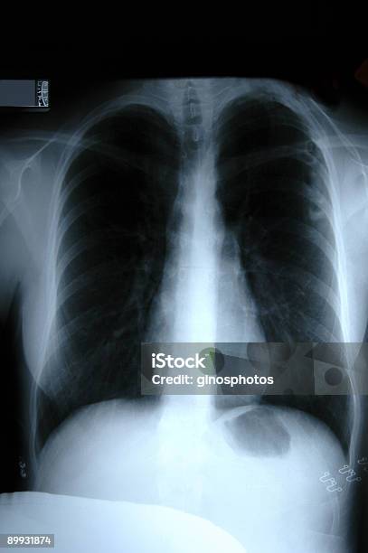 Radiografia Del Torace - Fotografie stock e altre immagini di Anatomia umana - Anatomia umana, Composizione verticale, Dati