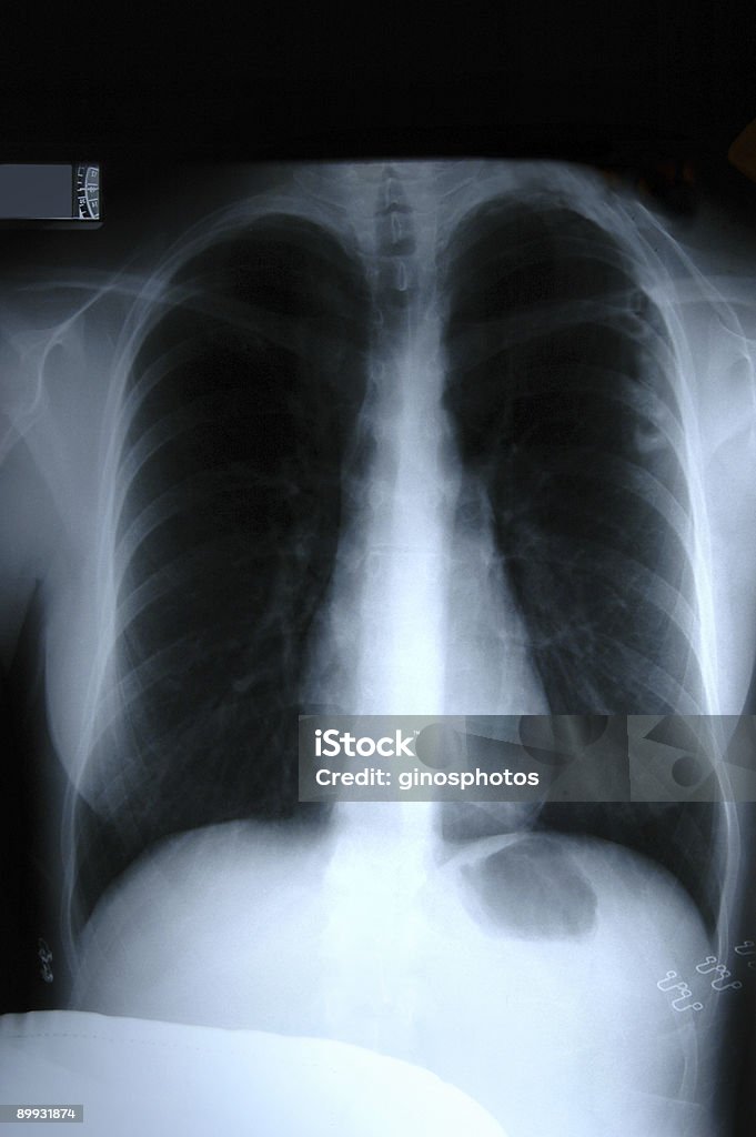 X-레이 of 토르소 - 로열티 프리 X-레이 스톡 사진