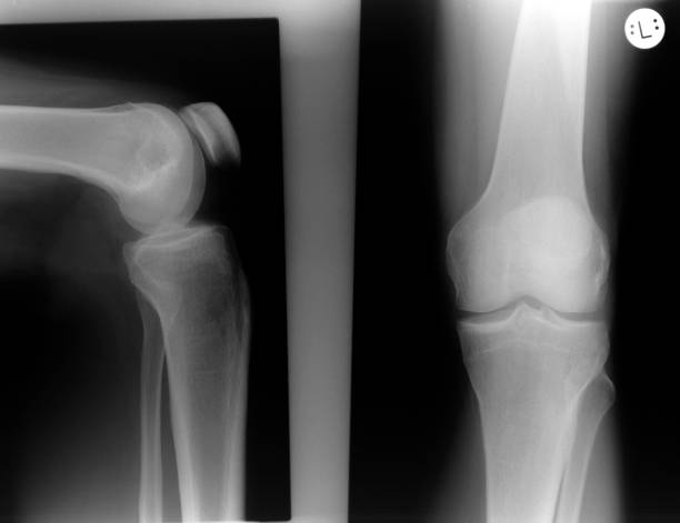 istock Roentgen picture from the knee 899331292