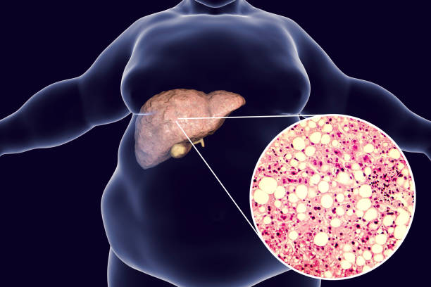 Obese man with fatty liver Obese man with fatty liver, 3D illustration and photomicrograph of liver steatosis. Conceptual image for non-alcoholic fatty liver disease light micrograph stock pictures, royalty-free photos & images