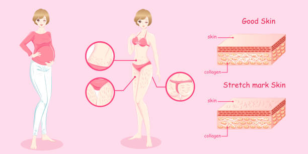 130+ Stretch Marks Stock Illustrations, Royalty-Free Vector Graphics & Clip  Art - iStock