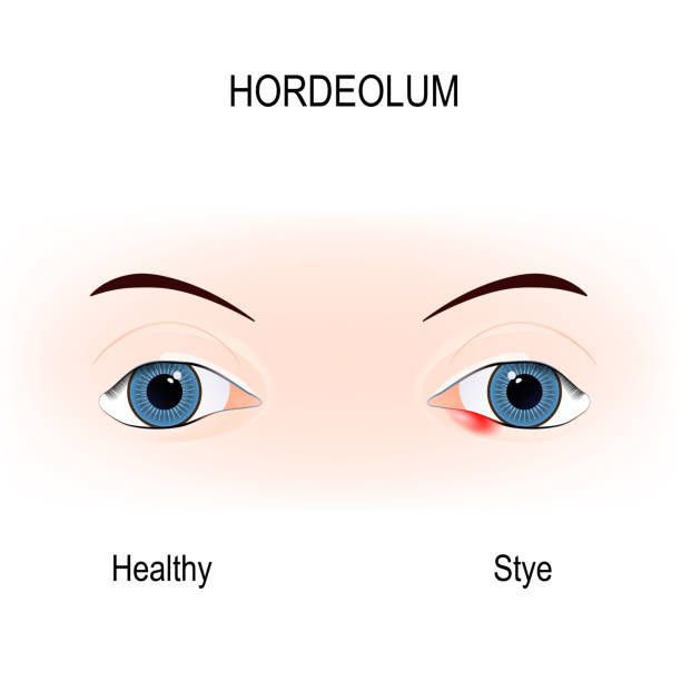 istock Eyes of human. stye. external hordeolum of lower eyelid. 899654164