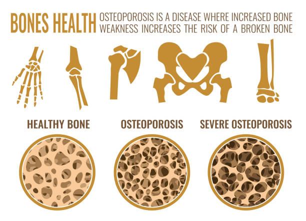 osteoporose-stufen-bild - osteoporose stock-grafiken, -clipart, -cartoons und -symbole