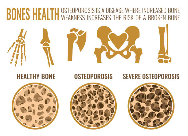 ilustrações, clipart, desenhos animados e ícones de imagem de estágios de osteoporose - stage costume illustrations