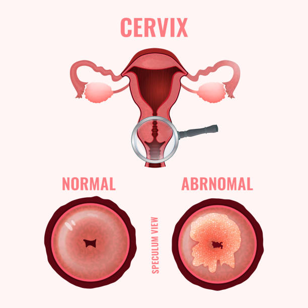 Cervical cancer image Cervical cancer development image. Detailed vector illustration with uterus and cervix carcinoma. Biology, anatomy, medicine, physiology and healthcare scientific concept. pap smear stock illustrations