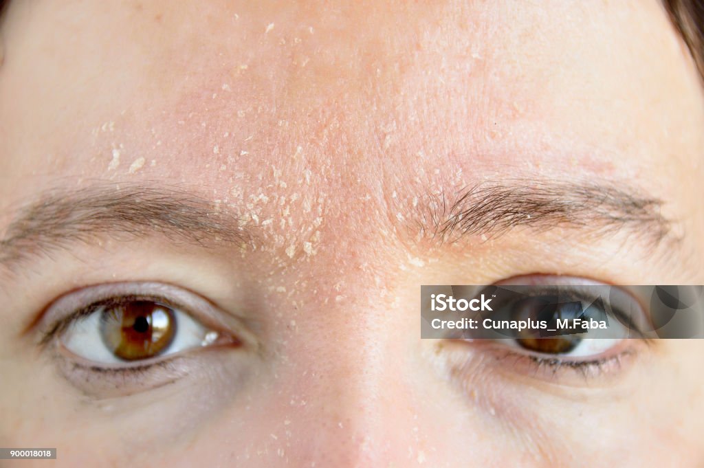 woman with atopic dermatitis woman with symptom of atopic dermatitis on brow and brows Skin Stock Photo